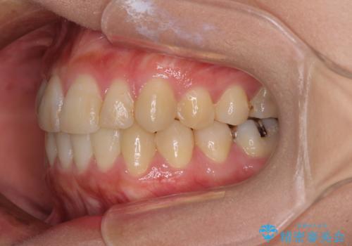上下の八重歯を治したい インビザラインと補助装置を用いた抜歯治療の治療後
