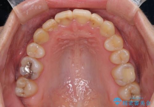 上下の八重歯を治したい インビザラインと補助装置を用いた抜歯治療の治療後