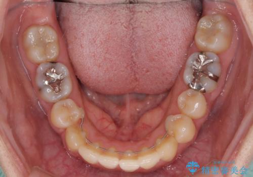 上下の八重歯を治したい インビザラインと補助装置を用いた抜歯治療の治療後