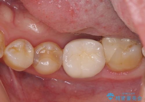 冷たいものがしみる セラミックインレーによるむし歯治療の治療前