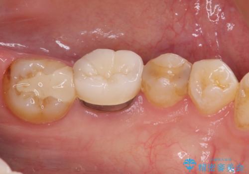 冷たいものがしみる セラミックインレーによるむし歯治療の治療前