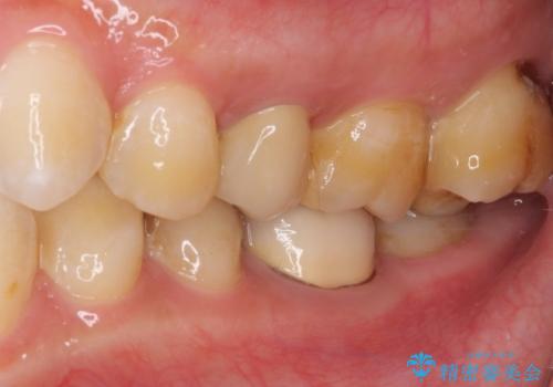 冷たいものがしみる セラミックインレーによるむし歯治療の治療前