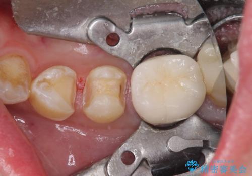 冷たいものがしみる セラミックインレーによるむし歯治療の治療中