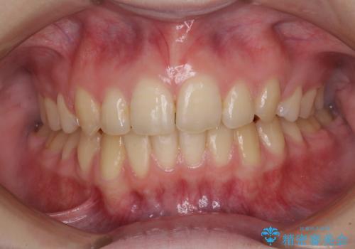 ワイヤー装置除去後のホワイトニング エクセレントコースの症例 治療前