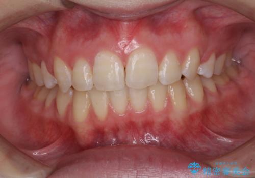 ワイヤー装置除去後のホワイトニング エクセレントコースの症例 治療後