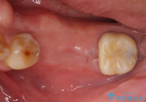 インプラント 失った奥歯の欠損補綴の治療前