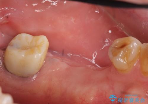 インプラント 失った奥歯の欠損補綴の治療前