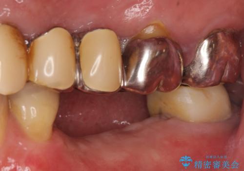 インプラント 失った奥歯の欠損補綴の治療前