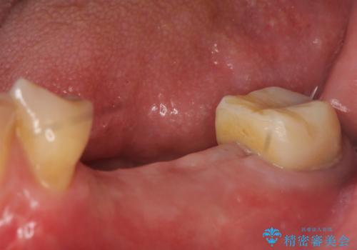 インプラント 失った奥歯の欠損補綴の治療前