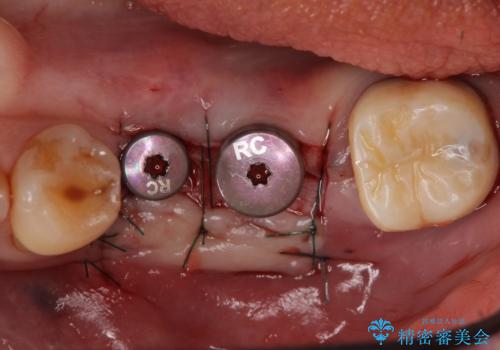インプラント 失った奥歯の欠損補綴の治療後