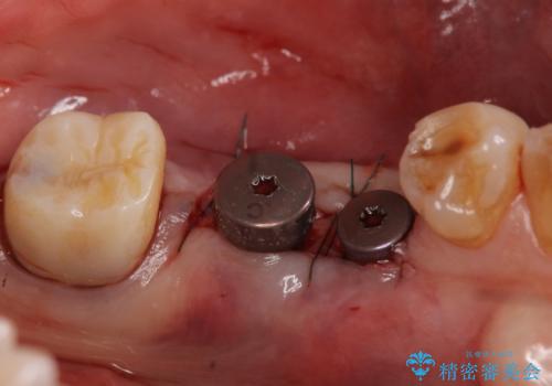 インプラント 失った奥歯の欠損補綴の治療後