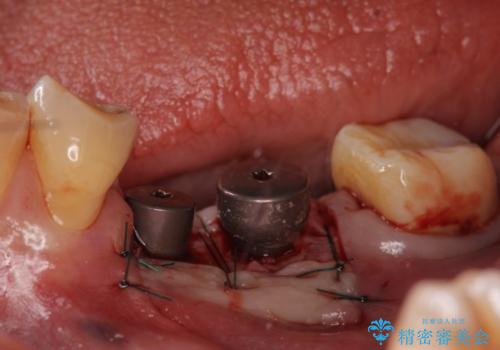 インプラント 失った奥歯の欠損補綴の治療後