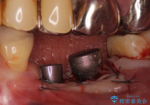 インプラント　失った奥歯の欠損補綴の治療後