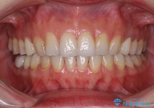 総合歯科治療　矯正治療と失活歯のセラミック補綴治療
