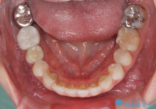 総合歯科治療　矯正治療と失活歯のセラミック補綴治療の治療後