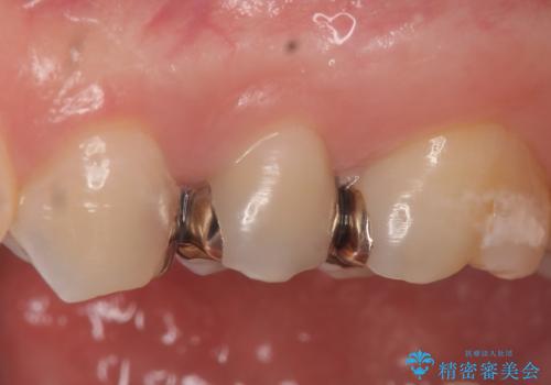 オールセラミッククラウン 銀歯がしみるの治療前