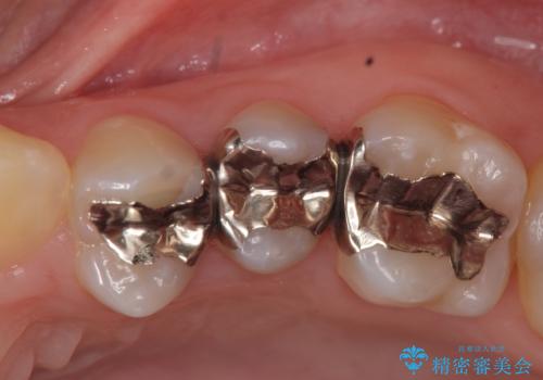 オールセラミッククラウン　銀歯がしみるの症例 治療前