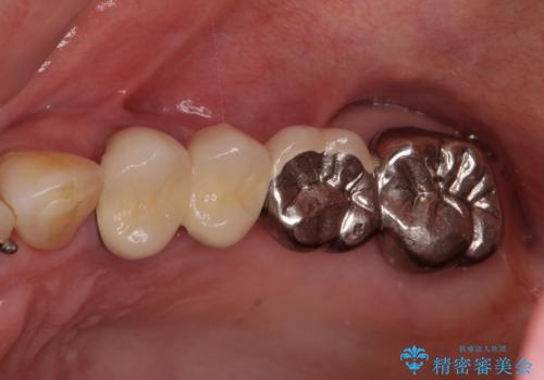 ブリッジの土台が割れて痛い インプラントによる補綴治療の症例 治療前