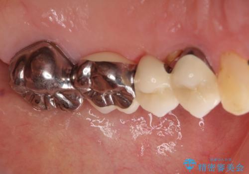 ブリッジの土台が割れて痛い インプラントによる補綴治療の治療前