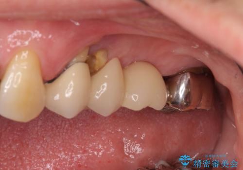 ブリッジの土台が割れて痛い インプラントによる補綴治療の治療前