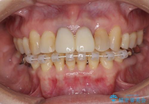 部分矯正とセラミック 前歯の審美治療の治療中