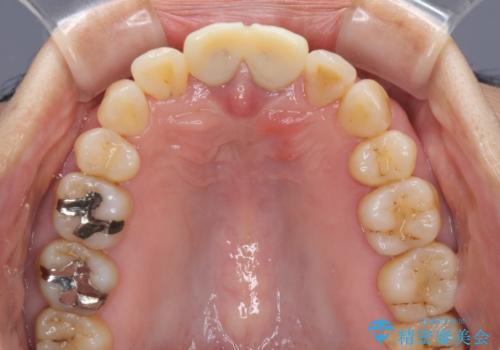 部分矯正とセラミック 前歯の審美治療の治療中