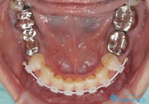 部分矯正とセラミック 前歯の審美治療の治療中