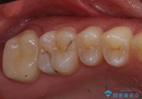 奥歯の虫歯　特殊な形をした歯の治療の症例 治療後