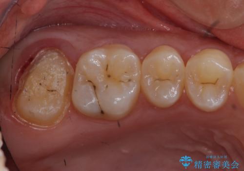 奥歯の虫歯 特殊な形をした歯の治療の治療中