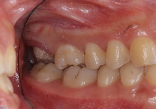 奥歯の虫歯　特殊な形をした歯の治療の治療中