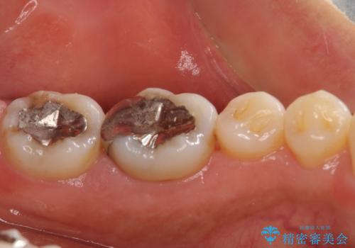 奥歯の虫歯　オールセラミッククラウンによる補綴治療の治療前