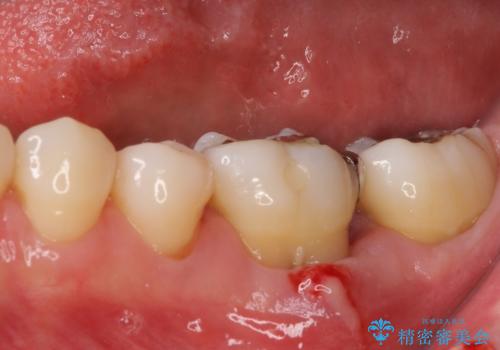 奥歯の虫歯　オールセラミッククラウンによる補綴治療