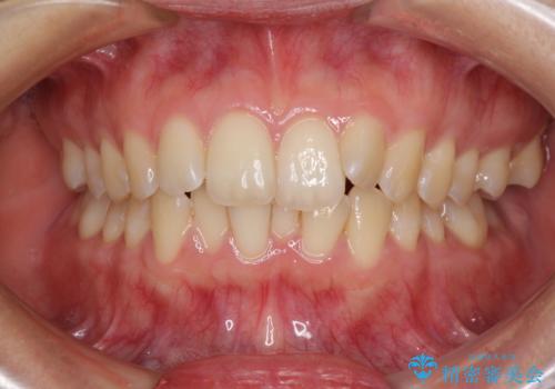 前歯のデコボコを解消 インビザラインによる矯正治療の症例 治療前