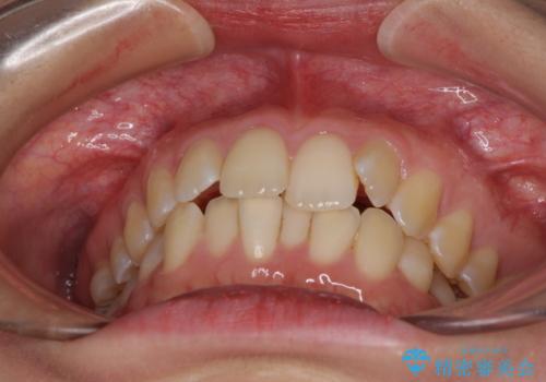 前歯のデコボコを解消 インビザラインによる矯正治療の治療前