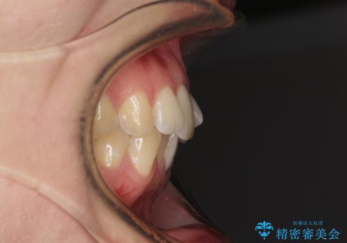 前歯のデコボコを解消　インビザラインによる矯正治療の治療前