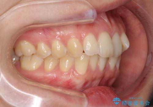 前歯のデコボコを解消 インビザラインによる矯正治療の治療前