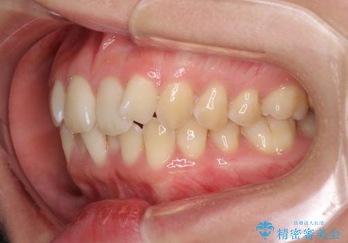 前歯のデコボコを解消 インビザラインによる矯正治療の治療前