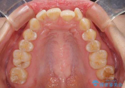 前歯のデコボコを解消　インビザラインによる矯正治療の治療前