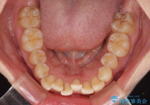 前歯のデコボコを解消 インビザラインによる矯正治療の治療前