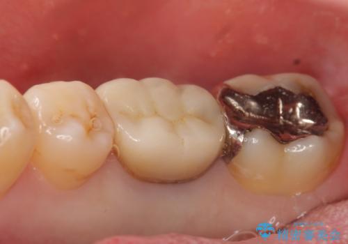 オールセラミッククラウン　歯茎から膿が出る歯の治療の治療前
