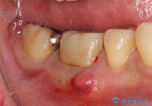 オールセラミッククラウン 歯茎から膿が出る歯の治療の症例 治療前