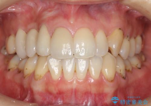 前歯の虫歯 とりあえずつけていた歯がとれたの症例 治療後