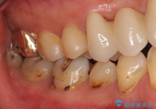 前歯の虫歯 とりあえずつけていた歯がとれたの治療後
