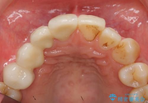 前歯の虫歯 とりあえずつけていた歯がとれたの治療後