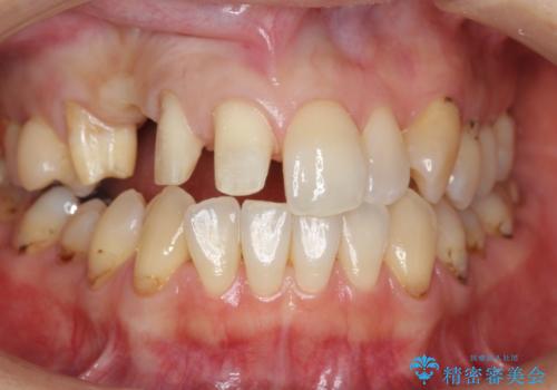 前歯の虫歯 とりあえずつけていた歯がとれたの治療中