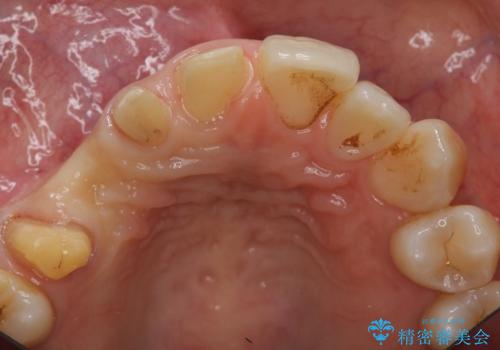 前歯の虫歯 とりあえずつけていた歯がとれたの治療中