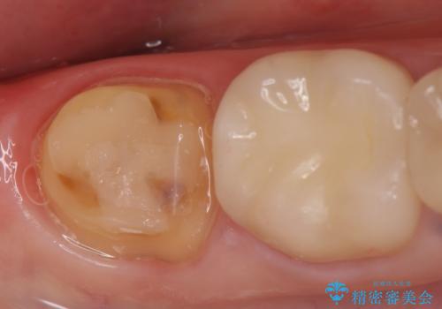 オールセラミッククラウン 違和感のある奥歯の治療の治療中
