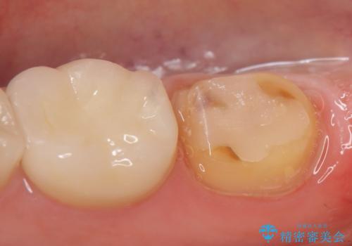 オールセラミッククラウン 違和感のある奥歯の治療の治療中