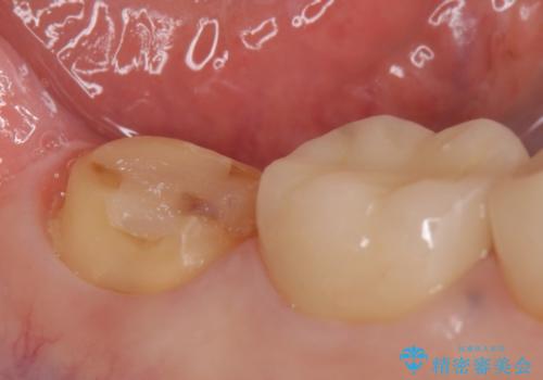 オールセラミッククラウン 違和感のある奥歯の治療の治療中