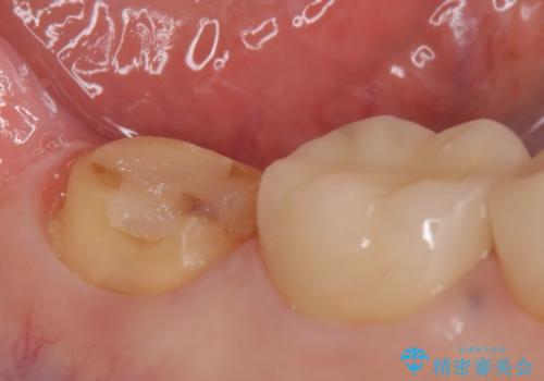 オールセラミッククラウン　違和感のある奥歯の治療の治療中